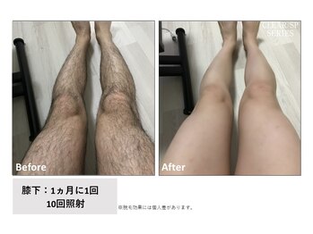 レア(Le'a)/【脚脱毛】