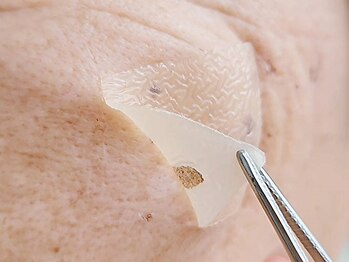 ローマピンク 札幌の写真/【驚きのポロッと体験】韓国最新肌施術でシミにアプローチ！植物の力で土台から輝く、ゆるがない美肌へ♪