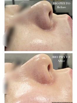 ミベル(MeBell)の写真/【韓国肌管理】話題のセラピール&ダクトピールでお肌悩みを改善し毛穴レスな水光肌に♪毛穴/くすみ/シミ◎