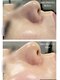 ミベル(MeBell)の写真/【韓国肌管理】話題のセラピール&ダクトピールでお肌悩みを改善し毛穴レスな水光肌に♪毛穴/くすみ/シミ◎