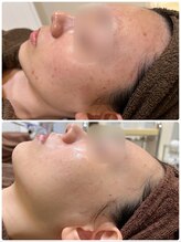 アンジェロ/【ニキビケア】肌育プログラム