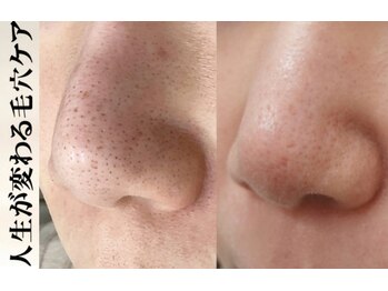 ブレア(Blair)/毛穴大掃除