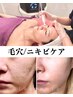 富山県初【プラズマ美肌革命】毛穴凹凸ニキビケア！真皮ケアで本気の肌質改善