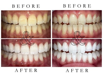 ジュエルホワイトニングの写真