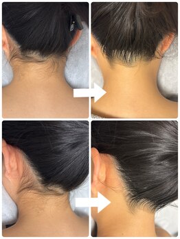 メイリリー(Maylilly)/全身脱毛・中高生（顔VIO省く）