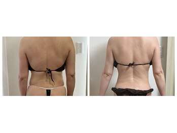 ビューティールーム 優美/痩身コース　ビフォーアフター