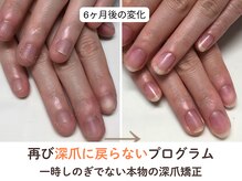 ネイルサロン プロムナード(nailsalon promnade)/長年の深爪を卒業