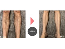 エミエット(Emiette)/男性ひざ下脱毛