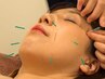 《美容鍼》全顔detox&リフトアップ◇75分 ¥1,1000→¥5,500