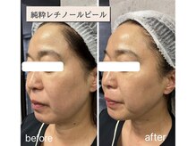 ユウユウ(YUYU)/純粋レチノールピール