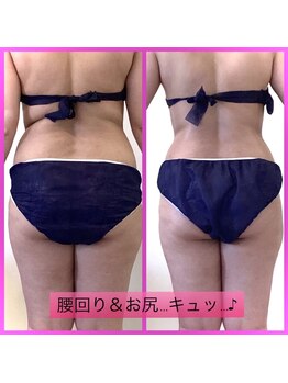 ソレイユ(Soleil)/【痩身人気No.1】美背中も得意◎