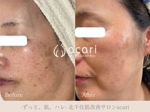 アカリ(acari)の雰囲気（お客様に合わせたホームケアで、肌改善を目指しましょう。）