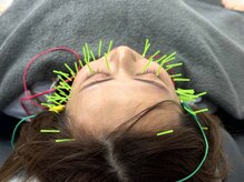 よしおか鍼灸整骨院/微弱電流リフトアップ美容鍼☆