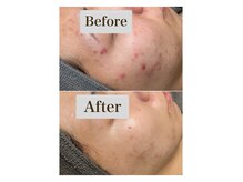 厳選国産ハーブで剥離ダウンタイムなし！毛穴ケア、ニキビケア◎