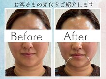 さくら鍼灸院 整骨院/美容鍼1