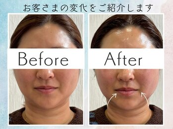 さくら鍼灸院 整骨院/美容鍼10