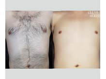 アップパイン(UPPINE)/全身脱毛/¥8,250/大国町