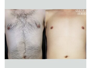 アップパイン(UPPINE)/全身脱毛/¥8,250/大国町