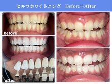 エクシアホワイトニング 岡崎店/岡崎エリア★口コミ・来店数No.1