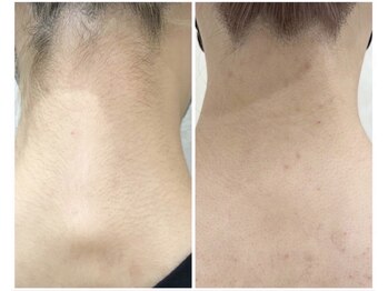 エピア 豊田店(Epia)/うなじ・襟足【シェービング付】