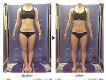 ビューティークリニックコダマ 宮崎南店/【2か月コース】M.H様（21歳）