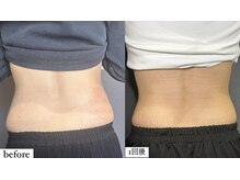 アエ メゾン(ae maison)/【施術1回】うきわ肉スッキリ！