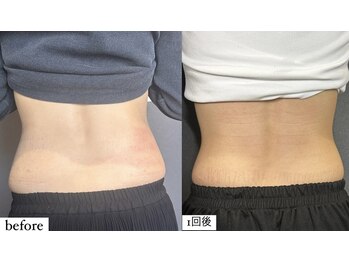 アエ メゾン(ae maison)/【施術1回】うきわ肉スッキリ!