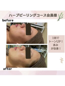 ビューティースリム リボーン 銀座店(reborn)/【ハーブピーリング】1回の変化!