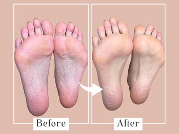 ベベ(Bebe)/女性/タコ・ガサガサお悩み