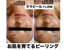 ルベル(Luvelle)/ララピール、LDM、ララマスク