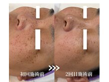 ソイ(Soi)/ほとんど諦めていたシミが