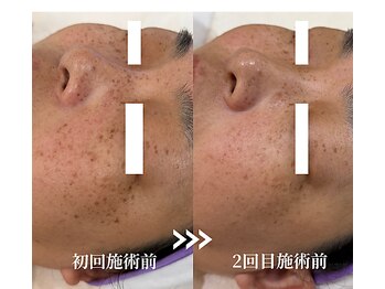 ソイ(Soi)/ほとんど諦めていたシミが