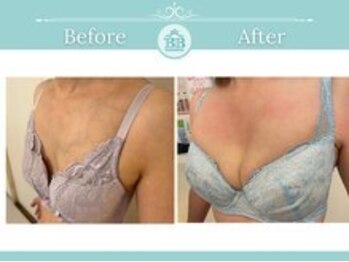 ベルビューティー(belle beauty)/【胸のたるみ・垂れ乳改善】症例