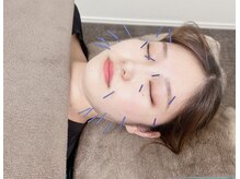越谷みんなの鍼灸整骨院/むくみ&肌トラブル改善で美顔に