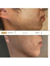 エスト(Est_.)/美容電気脱毛【毛抜き】