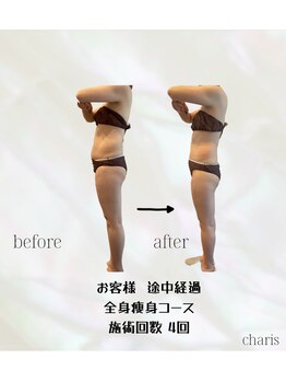 カリス(charis)/ビフォー&アフター