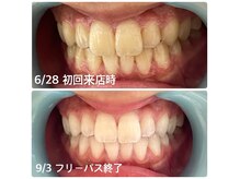 ホワイトニングショップ 福島店(WHITENINGSHOP)の雰囲気（お客様ビフォーアフター♪歯に透明感が出ました！）