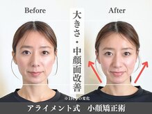 アライメントトウキョウ 表参道(Alignment TOKYO)/大きさ・中顔面改善