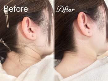 ピミル(PIMIL)/うなじ脱毛