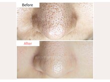 エクシア(Excia)/次世代毛穴洗浄