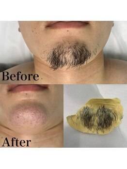 ハニーアイズ(Honey Eyes)/【男性ワックス脱毛】顔パーツ