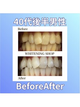 ホワイトニングショップ 西原店/40代後半男性☆BeforeAfter