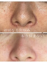 ミハン ボーテ(mihan.beaute)/【毛穴ひらき・くすみ】