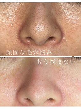 ミハン ボーテ(mihan.beaute)/【毛穴ひらき・くすみ】