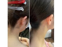 高機能【脱毛器】男女問わず喜ばれてます。うなじ／ヒゲなど対応