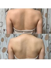 ソウビ(SowVi)/背中と二の腕引き締めお試し