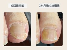 ルポ 伊勢/陥入爪ケア