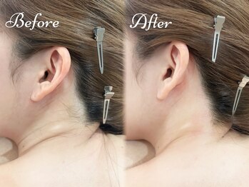 ピミル(PIMIL)/うなじ脱毛