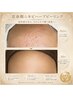 思春期ニキビで悩んでるお客様★国産ハーブピーリング￥5500→￥4500