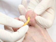 フットケアジャパン サロン日本橋/巻爪ケア